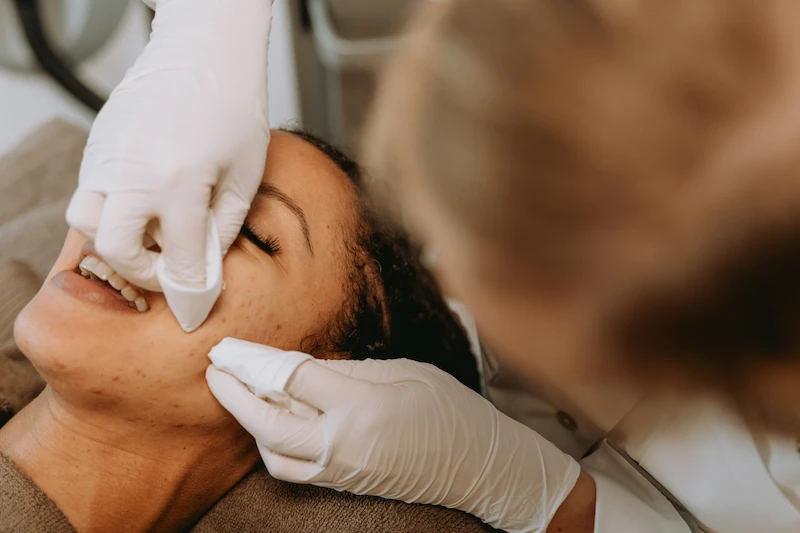 Blogpost Hormonale Acne Skin360